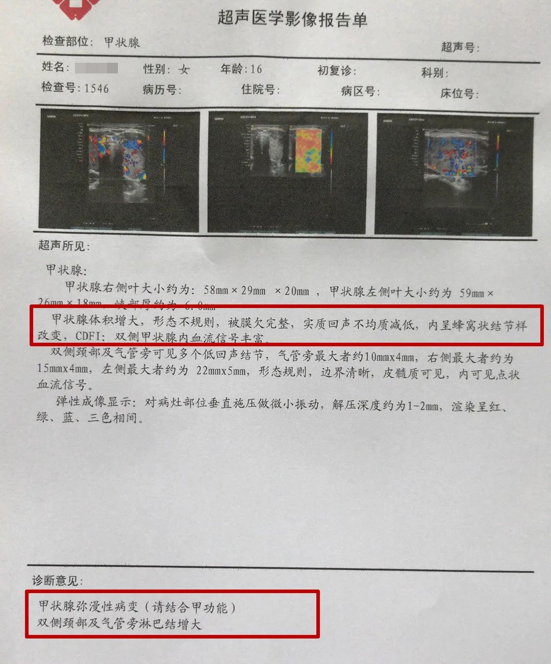 16岁女孩桥本氏甲状腺炎治疗,14岁女孩桥本甲状腺炎能治愈吗