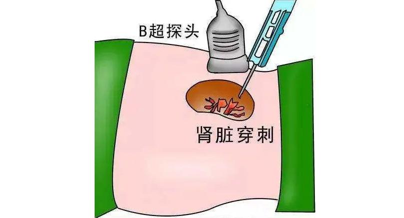 肾穿刺是怎么穿的,肾穿刺伤肾还是受伤