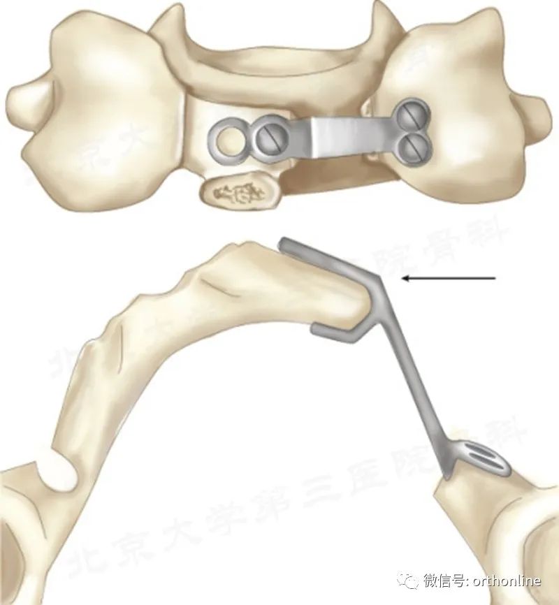 脊髓型颈椎病椎板成形术,椎间盘成形术指征