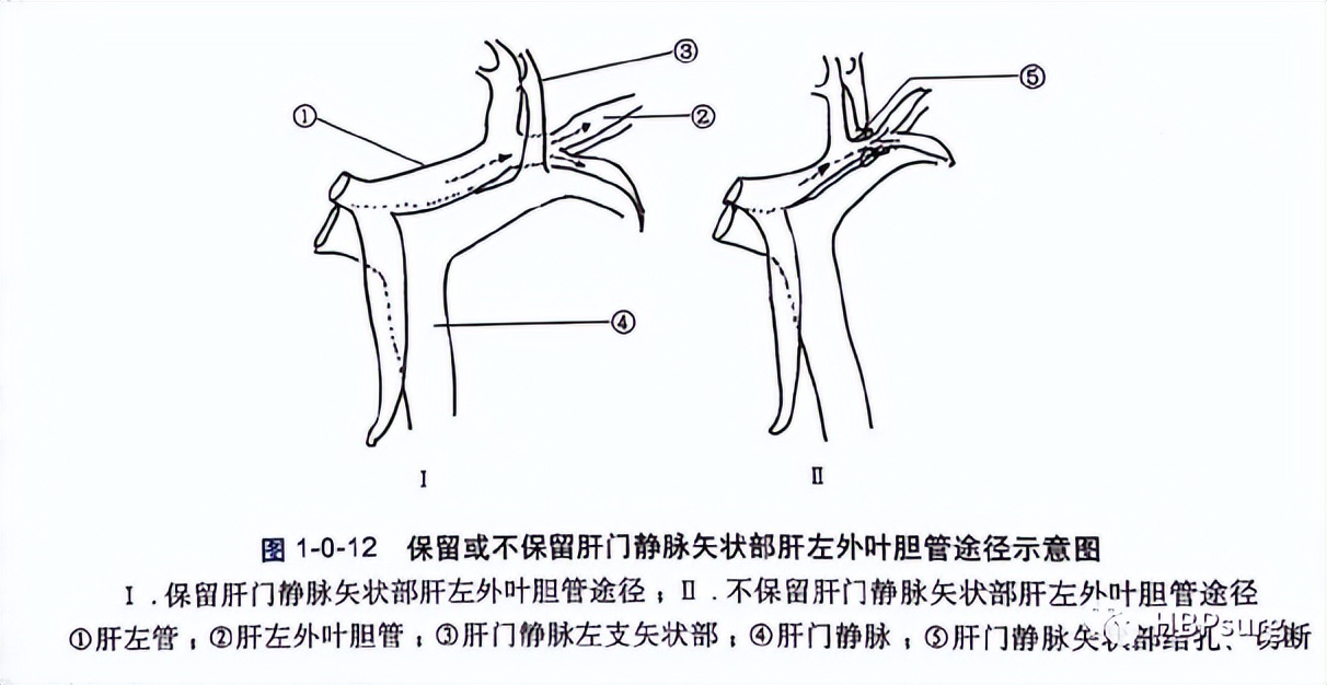 关于肝胆管结石治疗的入肝途径的总结