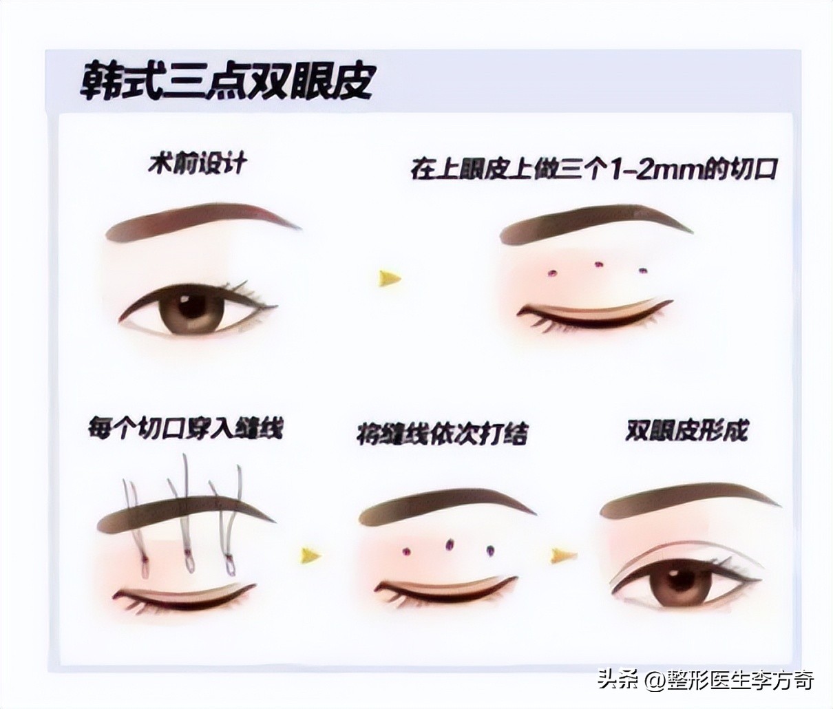 整形医院说双眼皮有几种技术,整形医生如何进行手术