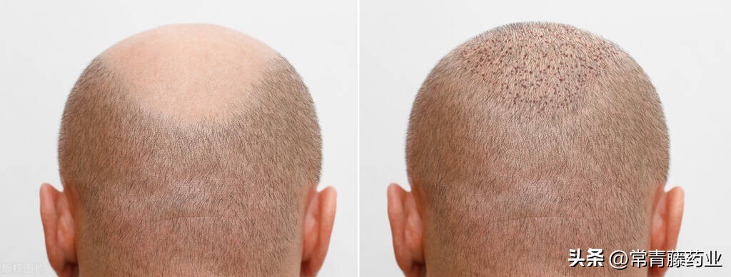 植发是唯一改善谢顶的方法吗,植发拆东墙补西