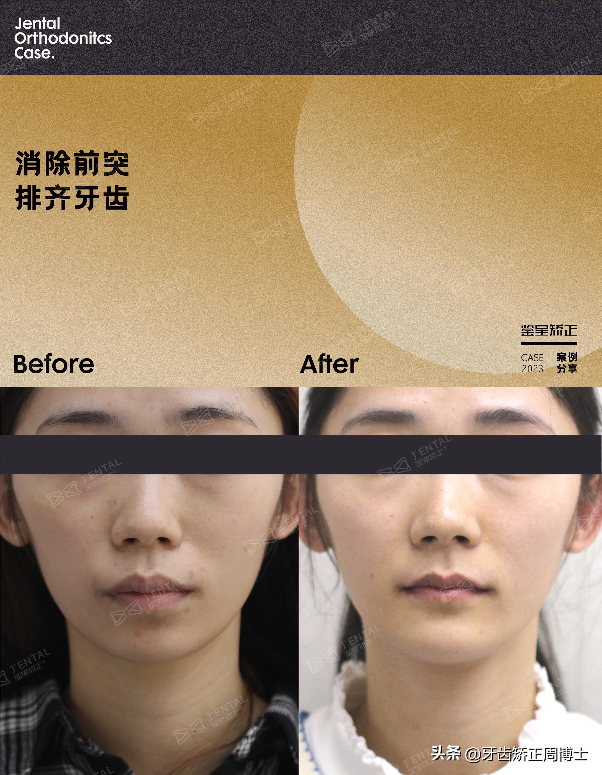 轻度拥挤龅牙咬合错位,龅牙导致牙齿咬合错位矫正价格