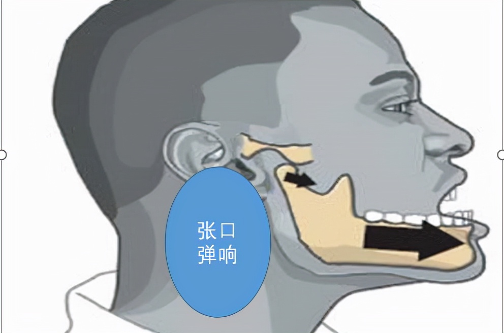 张嘴发出咔咔咔的声音,张嘴腮帮子咔哒响还疼怎么治