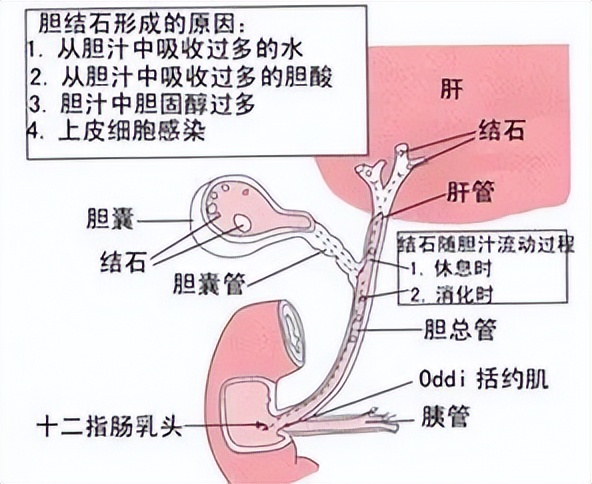 胆结石指南2022,胆结石诊疗指南最新版