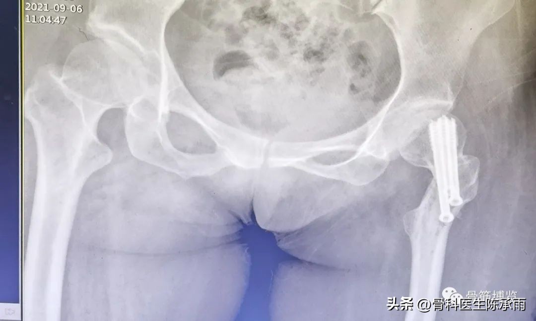 股骨颈闭合复位内固定术后护理,股骨颈骨折闭合复位的技巧