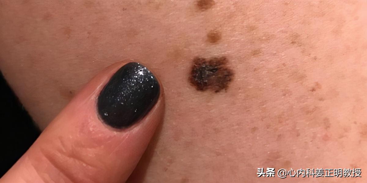 老年斑是只有老年人才会有的吗,老年人长老年斑对身体有影响吗