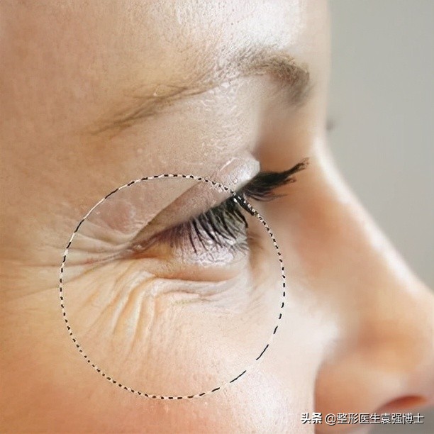 停止打玻尿酸脸会松弛下垂吗,停止打溶脂针后会怎样