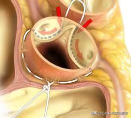 最先进的主动脉瓣二瓣叶畸形修复术（2020版）