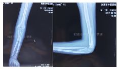 肱骨骨折取钢板怎样恢复,肱骨近端骨折切开复位内固定术