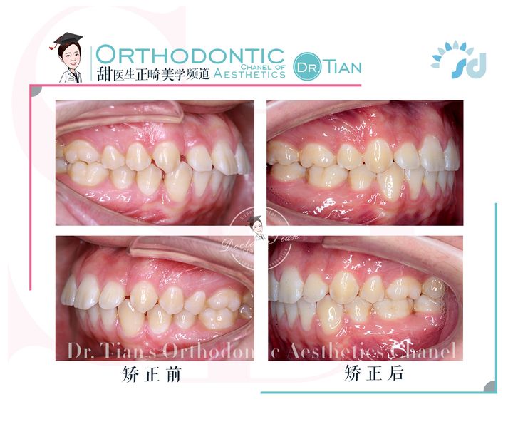 不拔牙矫正嘴凸下巴后缩案例,嘴瘪不拔牙矫正嘴会凸怎么办