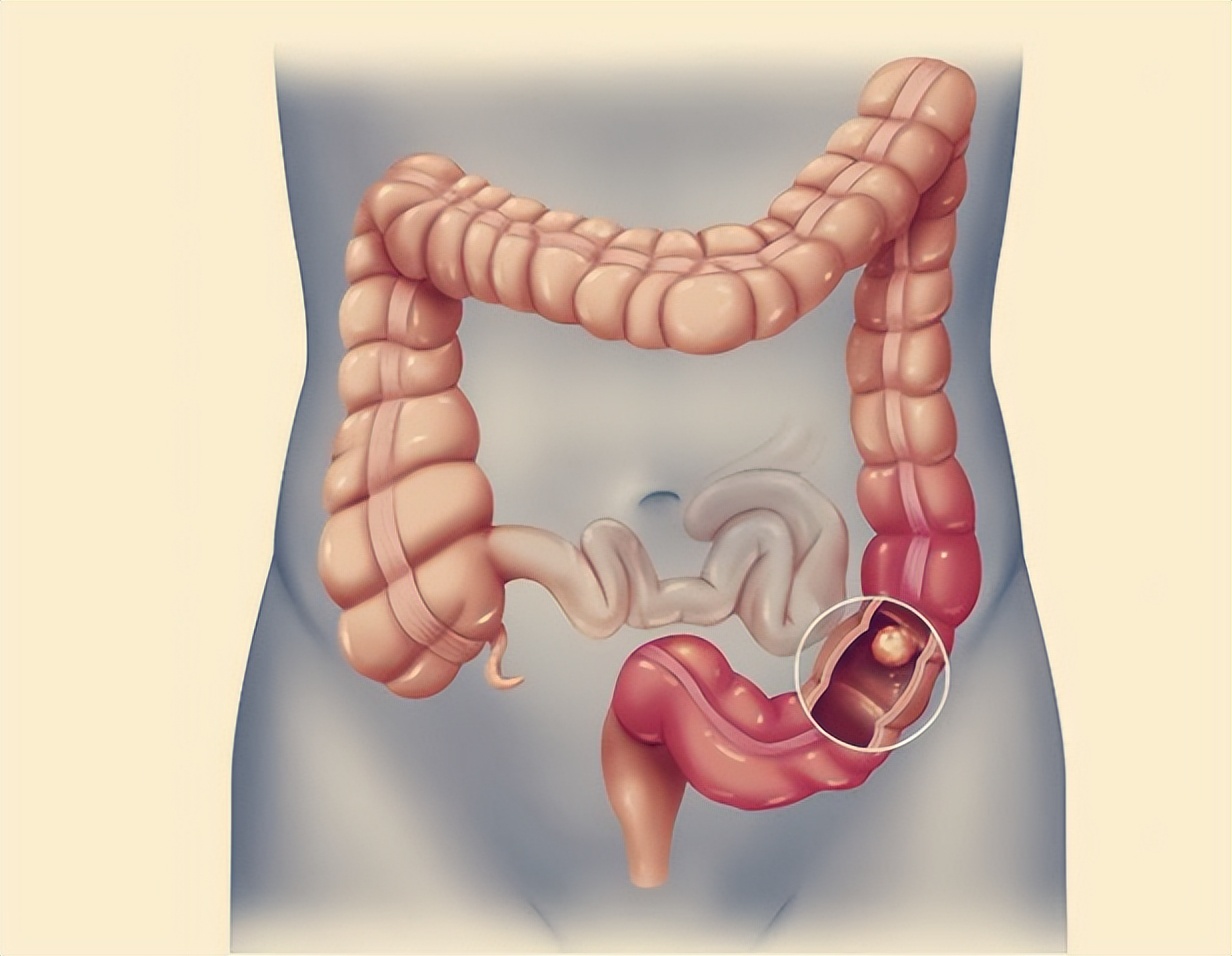 排便困难的要注意这几点,排便难预示着什么疾病