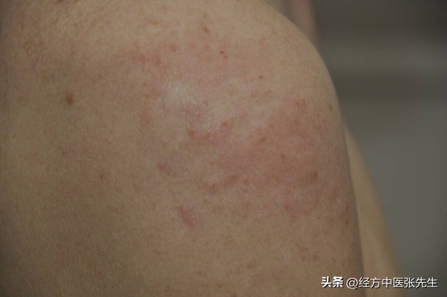 红斑丘疹擦什么中药,头皮疹用什么特效药