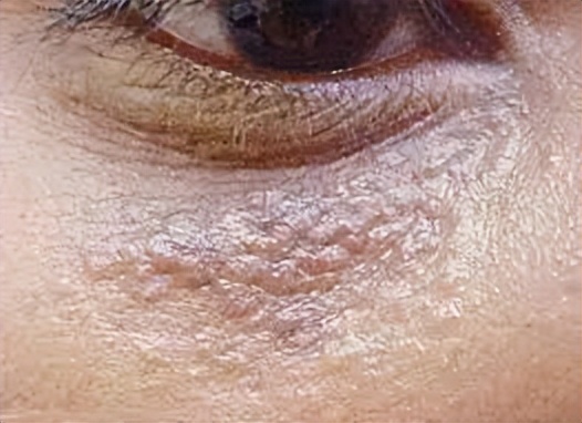 眼周起红色的小疙瘩是怎么回事,眼周起的小疙瘩别忽视