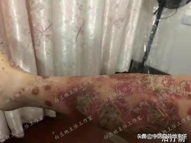 有关银屑病的故事,中医治疗银屑病故事