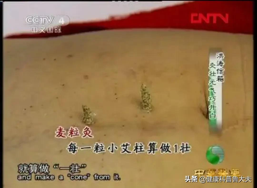 遭罪的干燥综合征，不妨试一试灸法，说不定柳暗花明又一村