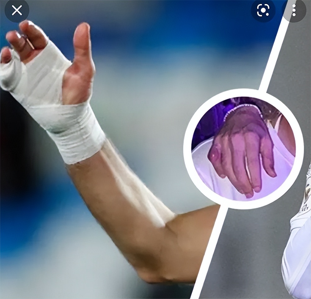 本泽马绷带打手腕,本泽马的右手金色绷带