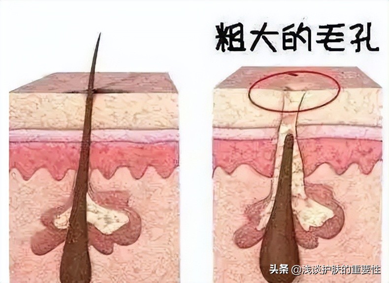 毛孔粗大收缩毛孔最有效果的方法,毛孔粗大收缩毛孔最快有效的方法