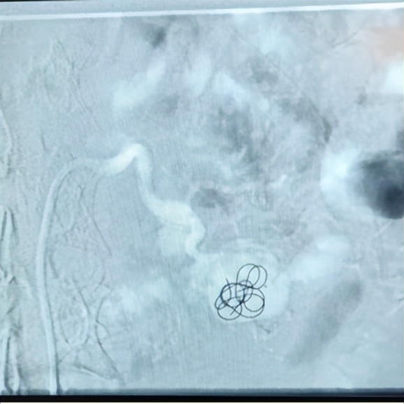 门医技术|区医院肿瘤与介入科成功解除藏在患者体中的“定时*弹炸**”——动脉瘤