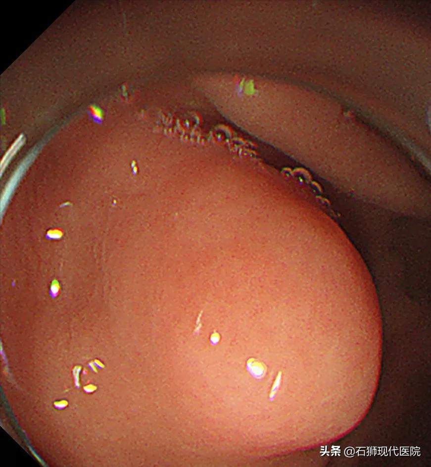 石狮医院有无痛胃镜吗,有哪些人不合适做胃镜