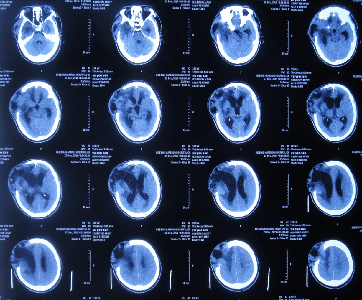 脑动脉瘤破裂手术后有脑水肿,动脉瘤开颅夹闭术出血