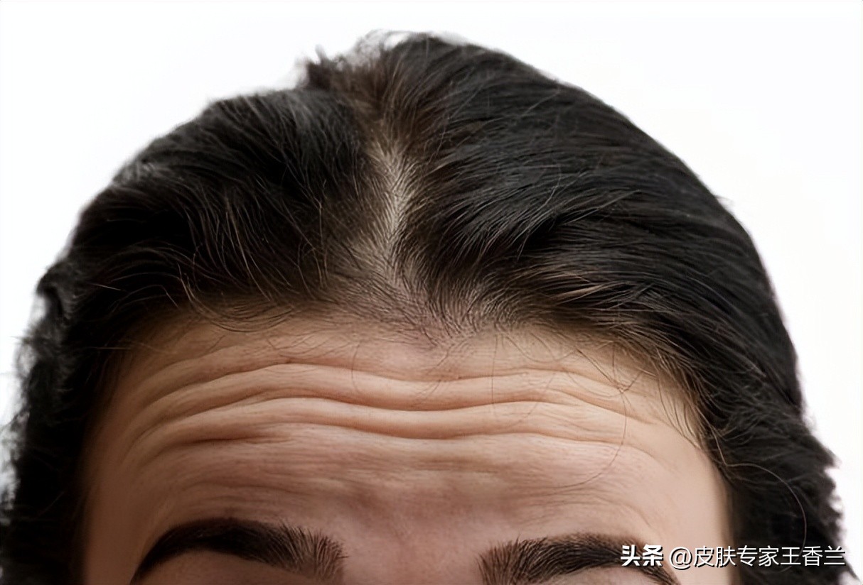 抬头纹要怎么治疗,抬头纹多该怎么办