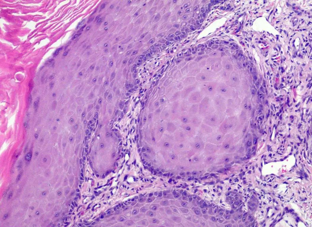 鳞状细胞癌是什么癌,鳞状细胞癌属于什么癌