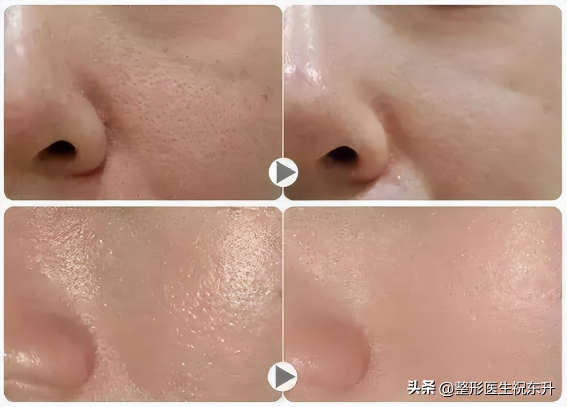 面部年轻化项目,面部年轻化案例