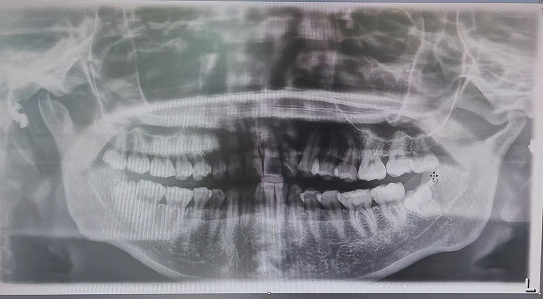 又贵又遭罪的漫漫补牙路