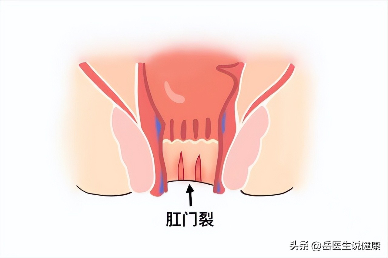 青少年患有肛裂正常吗,26岁老是肛裂
