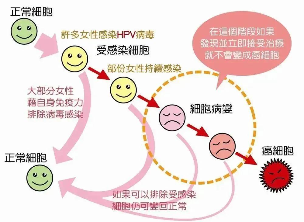 感染HPV=宫颈癌？