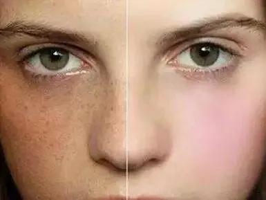 色斑形成的几个阶段和解决方法,色斑的形成原因及解决方法