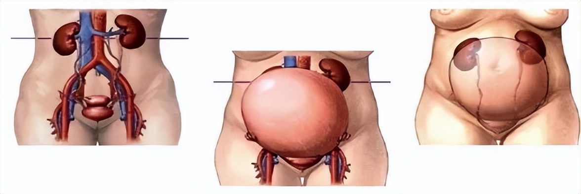 孕期尿频严重会减少羊水吗,孕期尿频的最佳解决方法