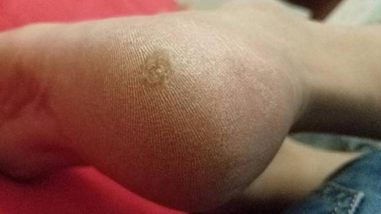 脚底板爱紫是什么原因,脚底板爱起皮是怎么回事