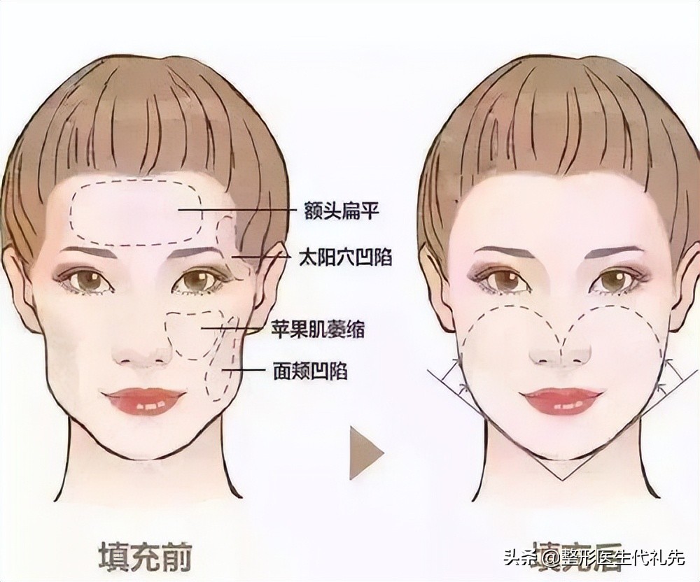 面部凹陷可以通过什么医美改善,面部整形面部凹陷怎么修复