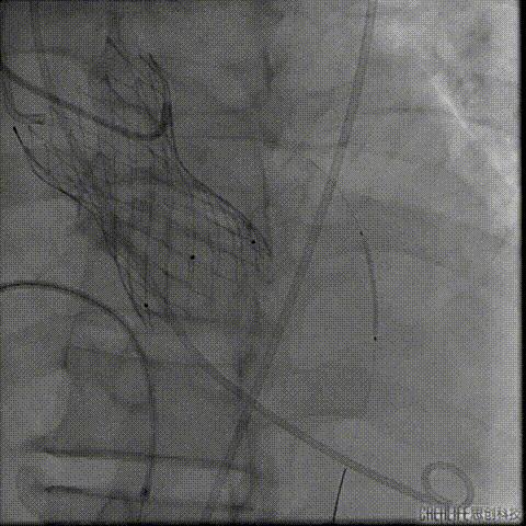 病例回顾与分享,腹膜后血肿介入治疗