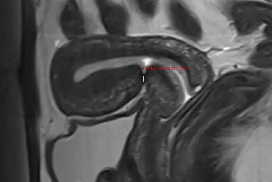 剖宫产术后瘢痕妊娠彩超诊断依据,剖腹产后子宫筛查可以不做吗