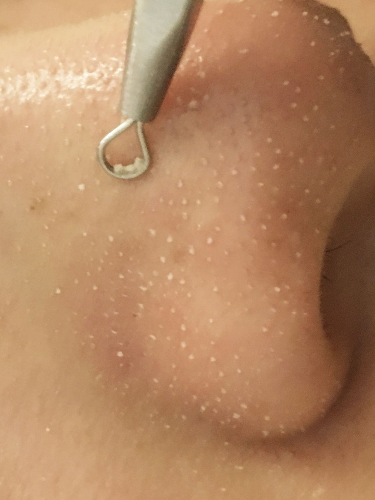 鼻子上油脂粒去除后怎么收缩毛孔,鼻子上长了个类似痘的东西