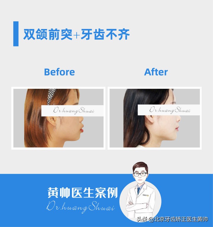 嘴凸的人怎么笑起来好看,嘴凸怎么让自己不焦虑