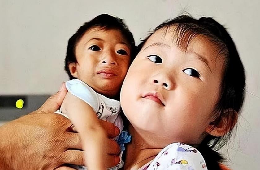 湖南一产妇生下“小猴子”,湖南产妇生下猴女孩上节目