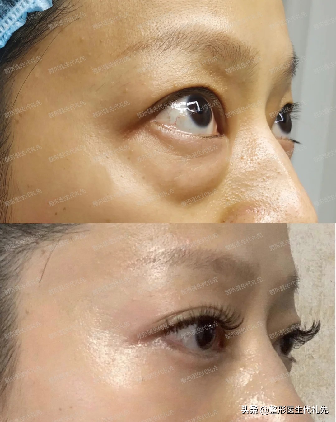 皮肤松弛型的眼袋是不是假性眼袋,眼袋上的小细纹是怎样形成的