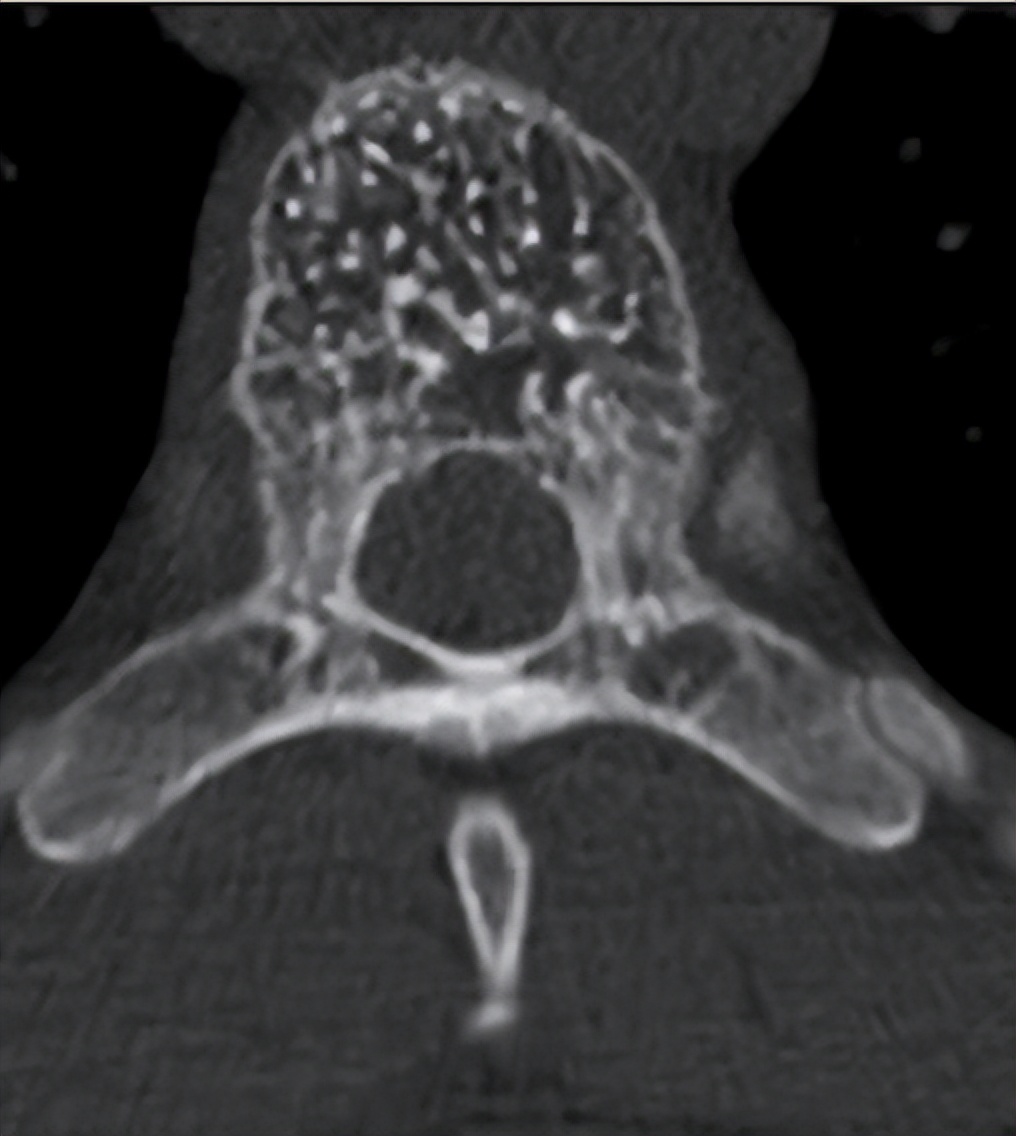 s2椎体内血管瘤属于浅表血管瘤吗,椎体血管瘤有恶性的吗需要穿刺吗