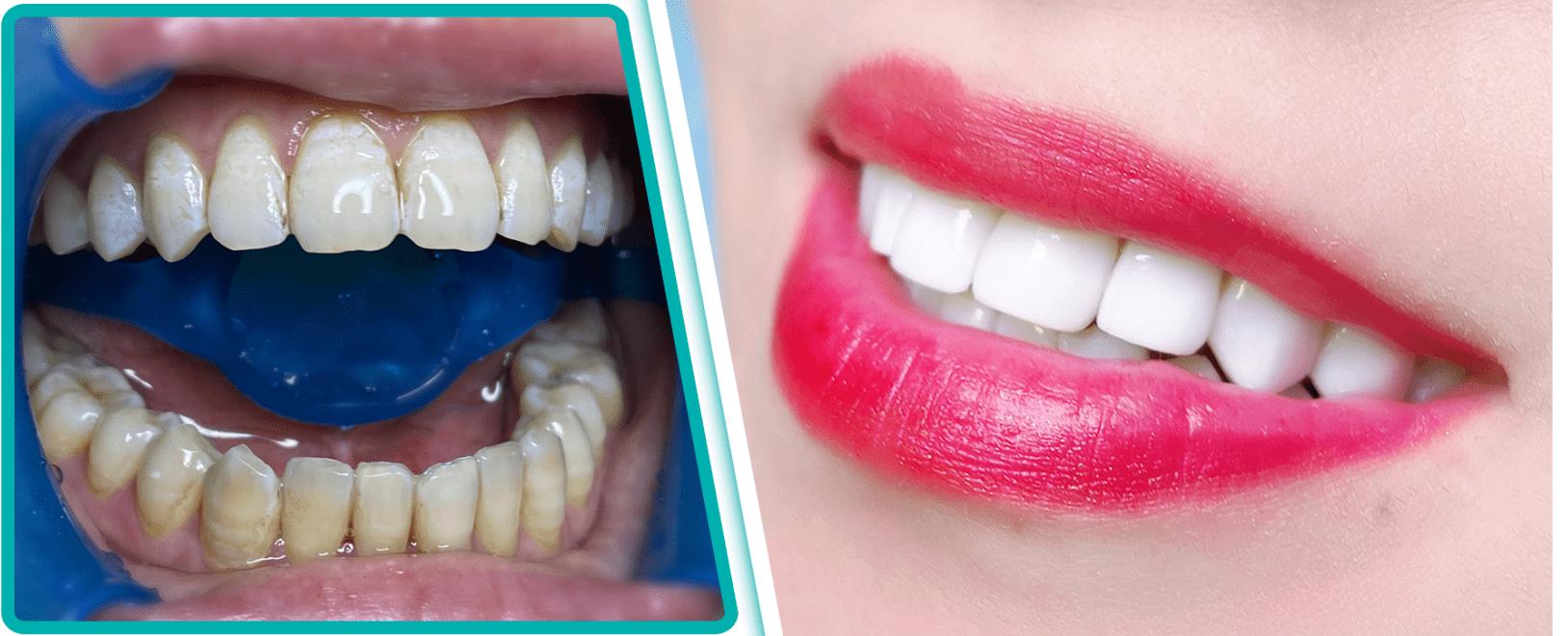 氟斑牙是刷牙引起来的吗,氟斑牙可以洗下去吗