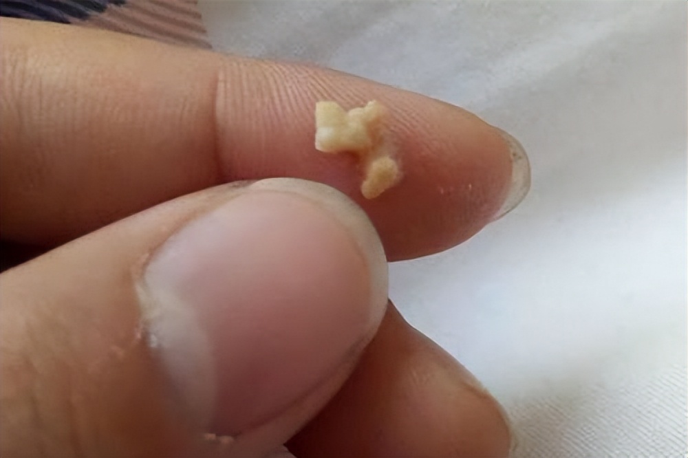 牙齿上抠下来的白色的东西臭臭的,从牙齿里抠出的臭臭的东西是什么