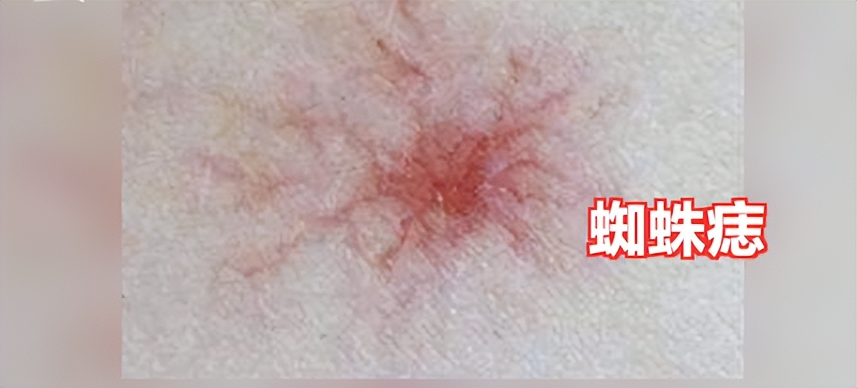 一旦发现自己身上有这4个征兆,肝癌有痣的前兆