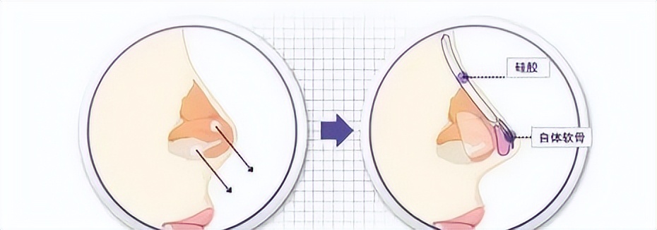 【协和科普】同是隆鼻，为什么有的自然有的一眼被看穿？