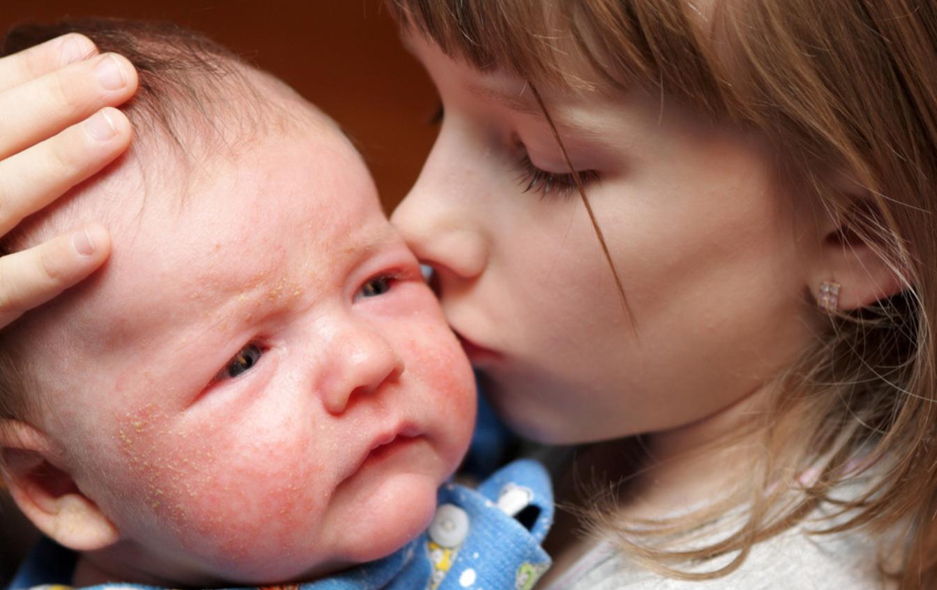 两个月宝宝脸上长小红痘痘痒,两个月宝宝用了面霜长痘痘了