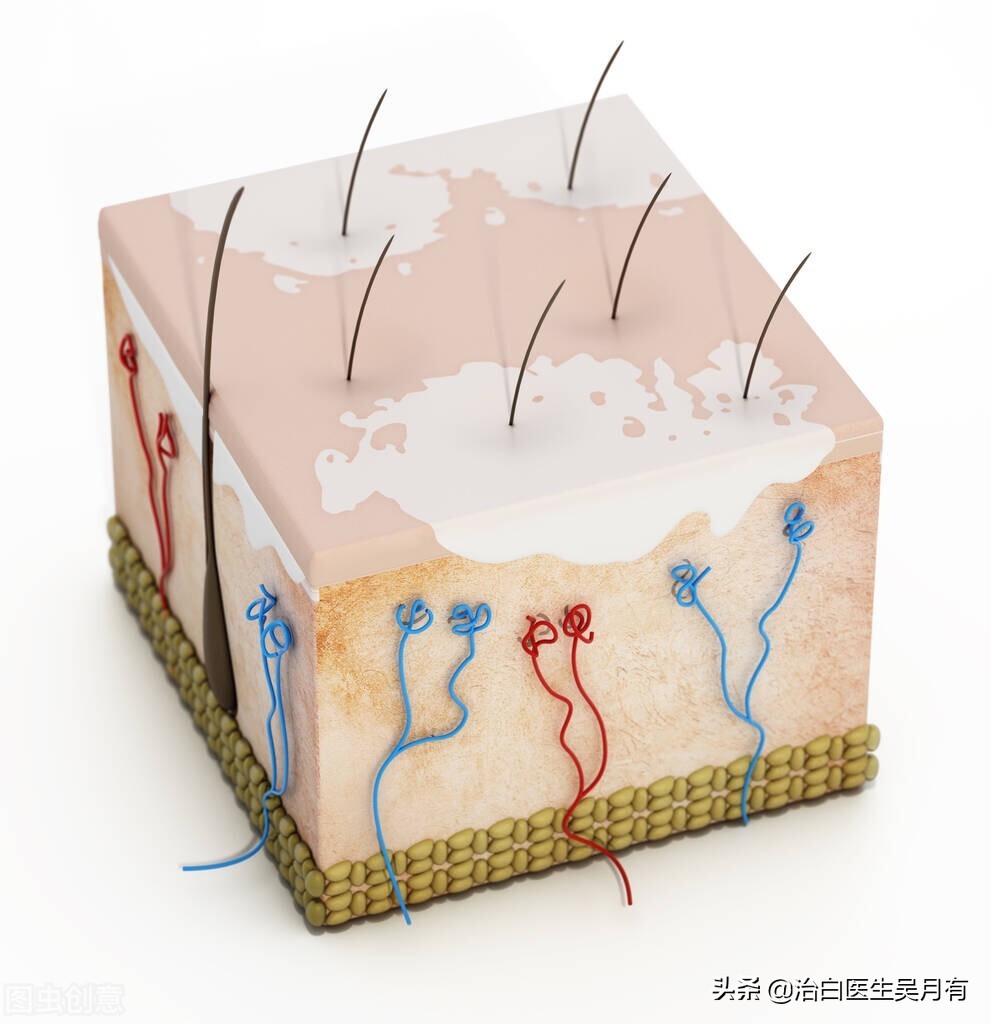先天性白斑是不是无色素痣,无色素痣白斑怎么治疗