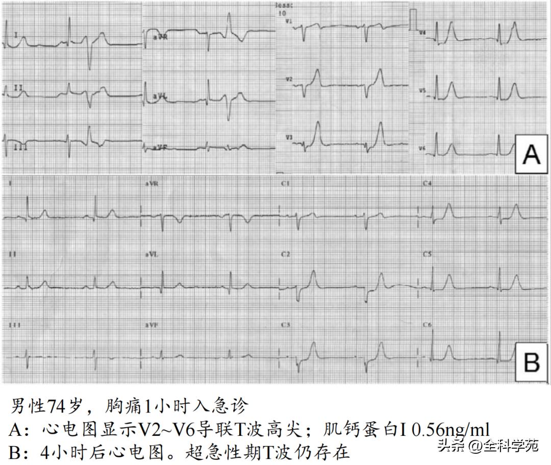 t波高尖心电图判断标准,t波高尖判断标准