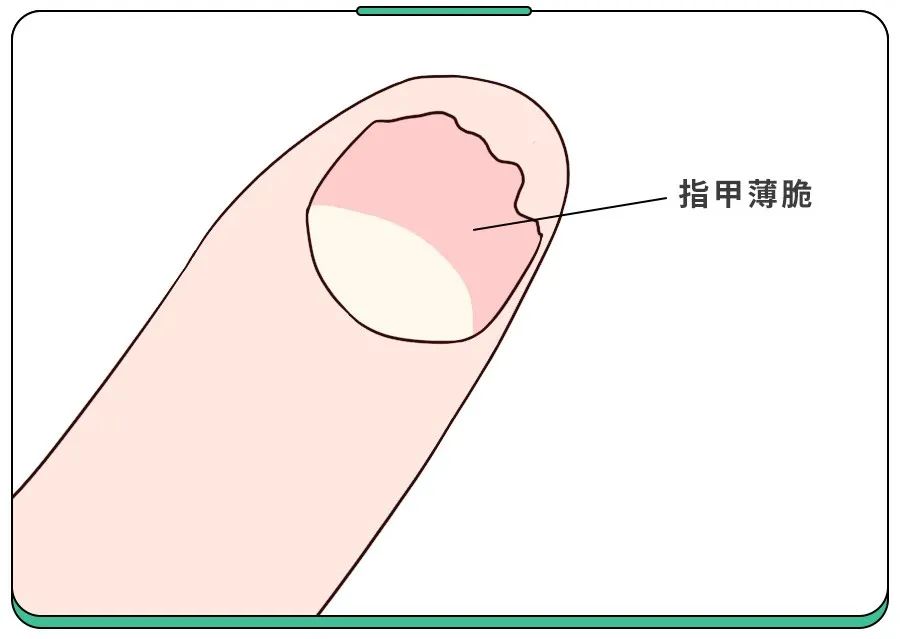 白斑、薄脆、凹陷，娃指甲有异常，不是缺营养，可能暗藏疾病